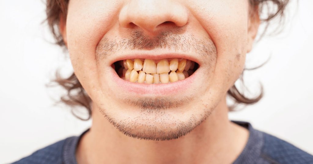 The Most Common Causes of Teeth Stains